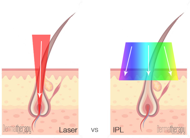 laser-vs-ipl.jpg